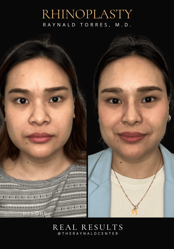 rhinoplasty42