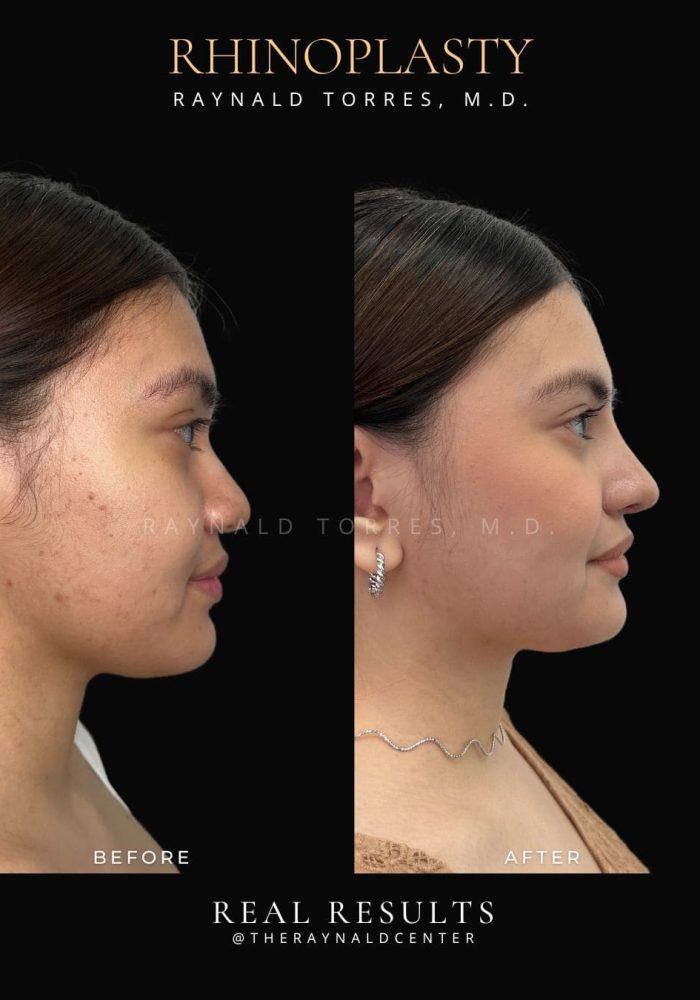 rhinoplasty43