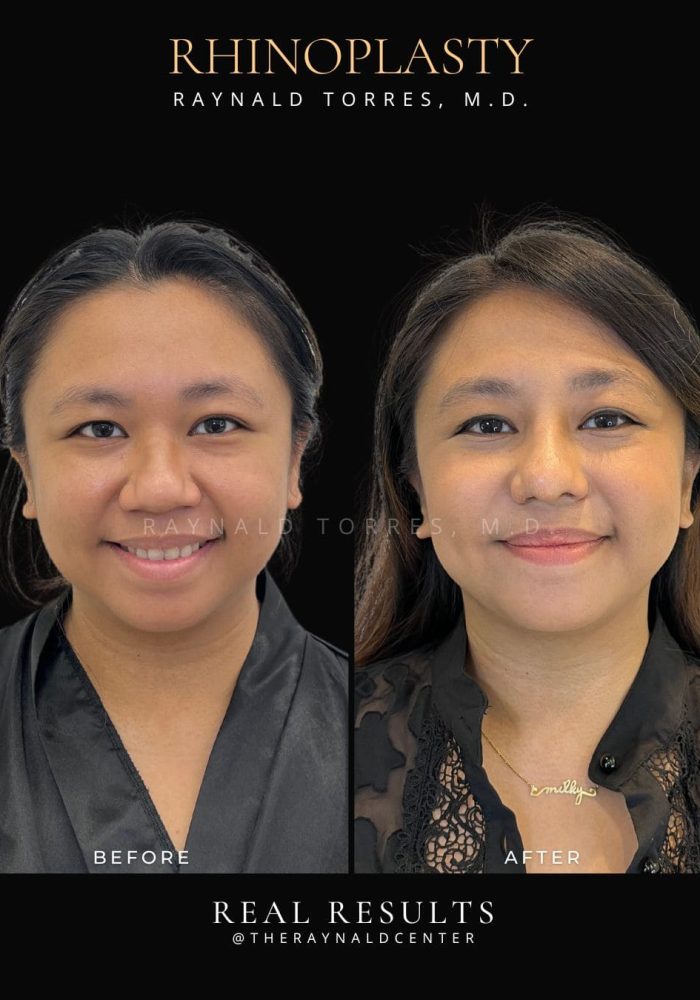 rhinoplasty44