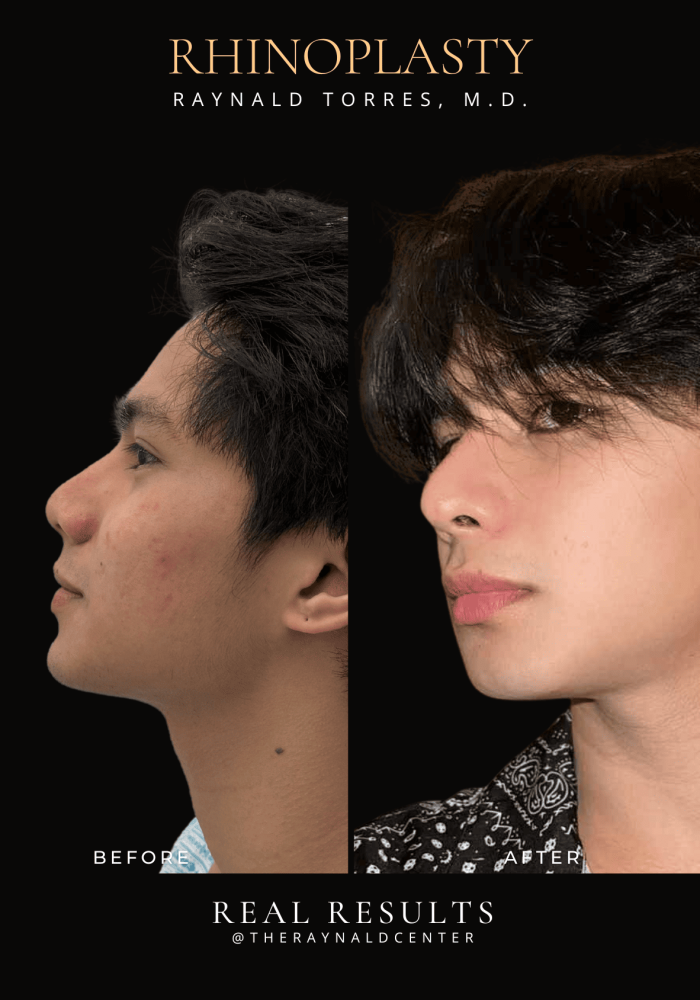 rhinoplasty45