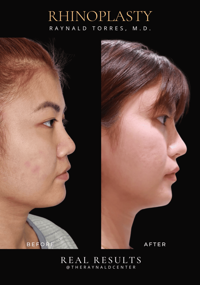 rhinoplasty46