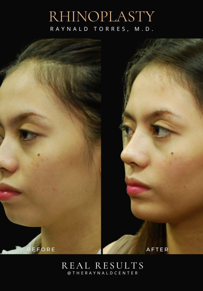 rhinoplasty47
