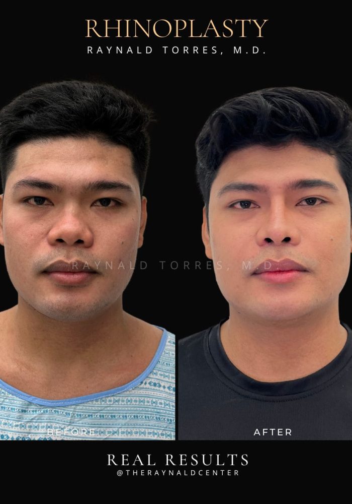 rhinoplasty48