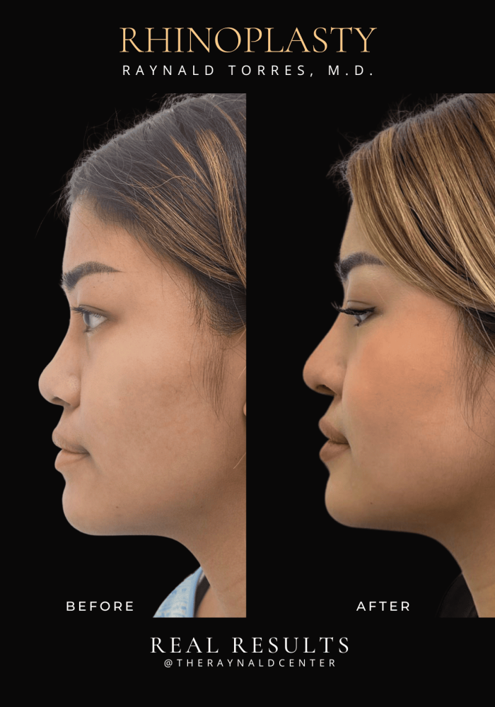rhinoplasty49