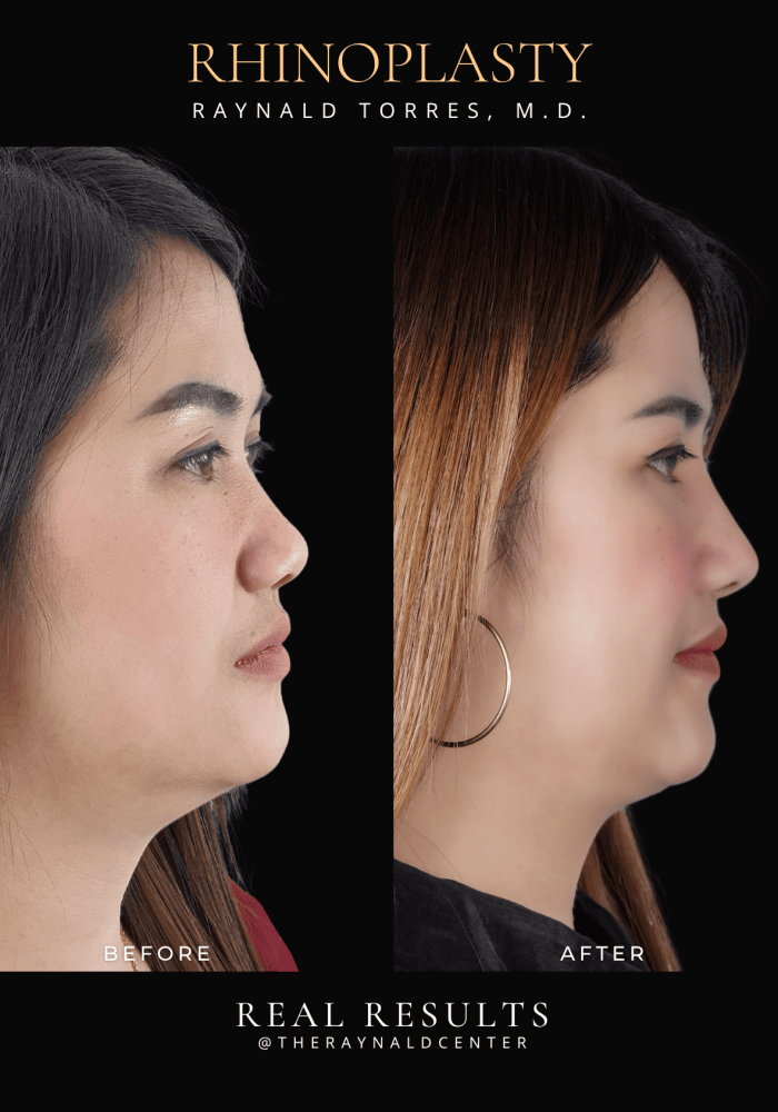 rhinoplasty5