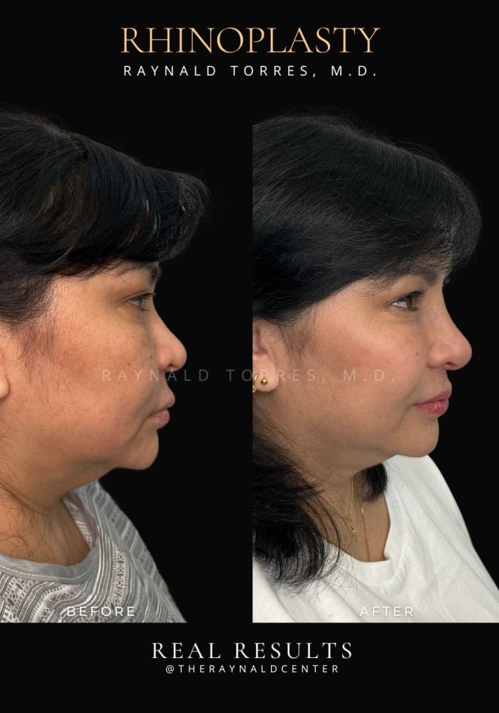 rhinoplasty50