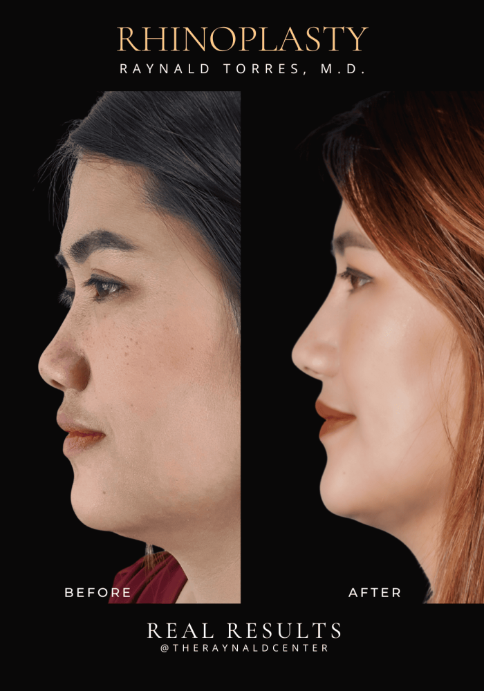 rhinoplasty51