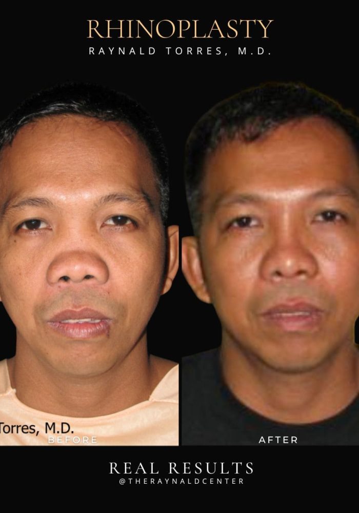 rhinoplasty53