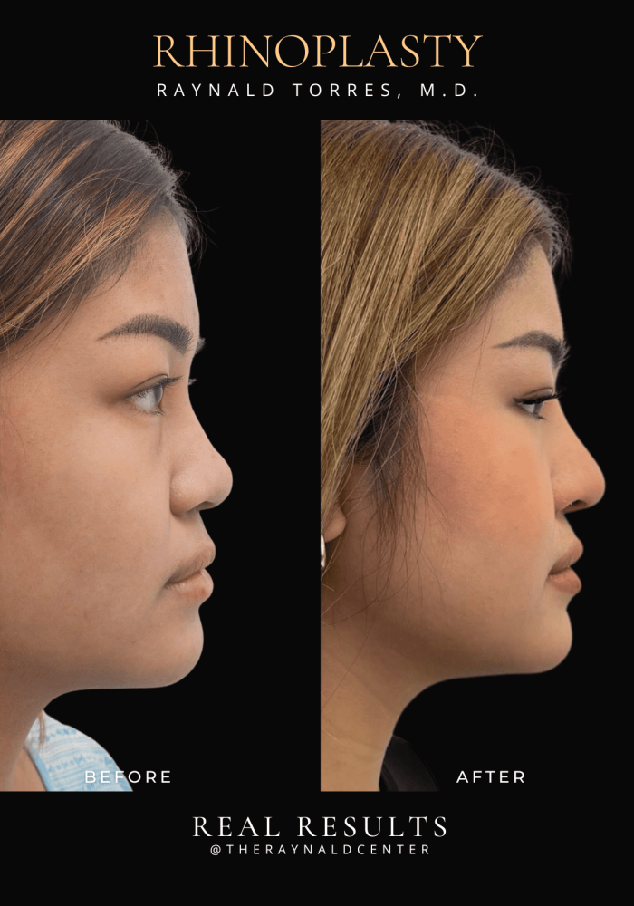 rhinoplasty54