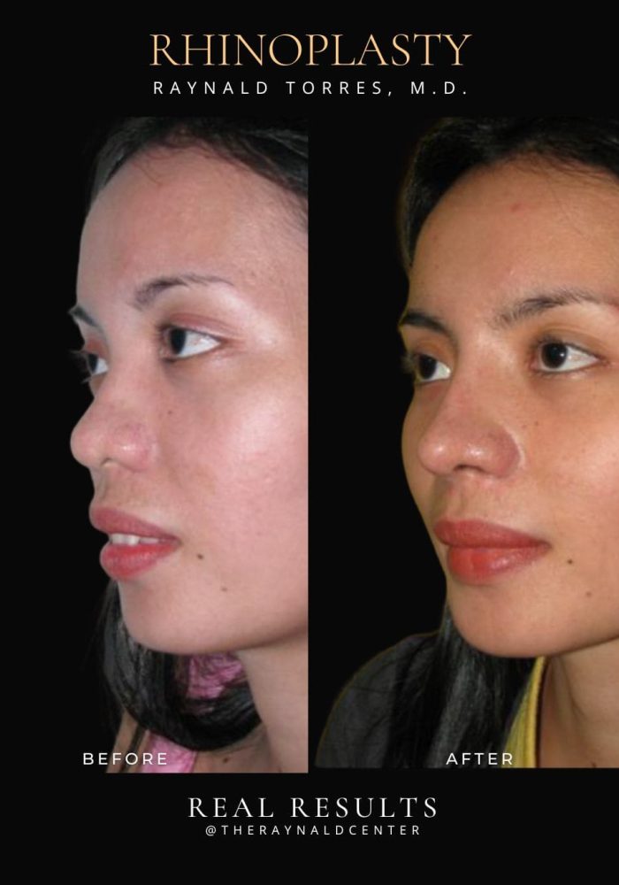 rhinoplasty55