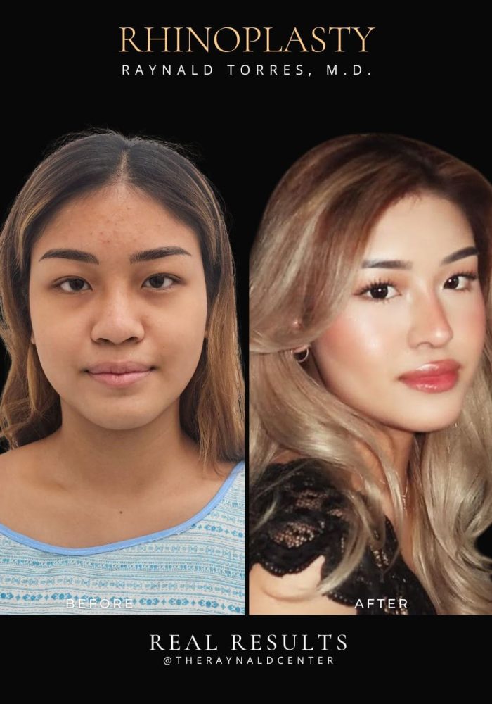 rhinoplasty56