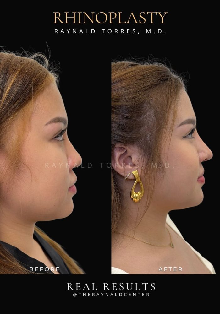 rhinoplasty57