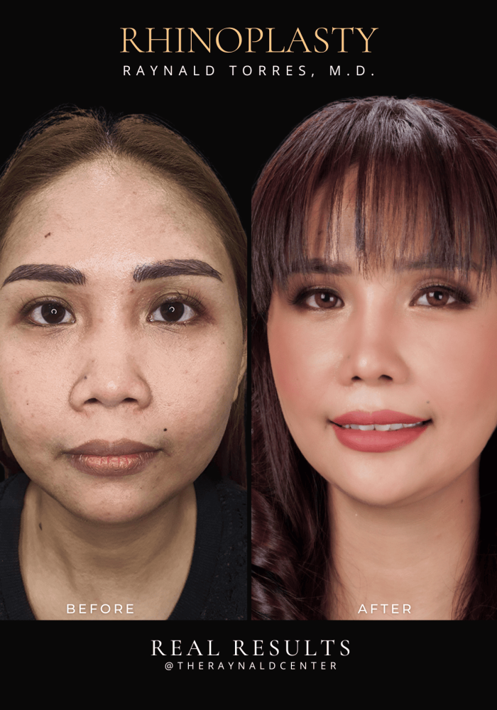rhinoplasty58