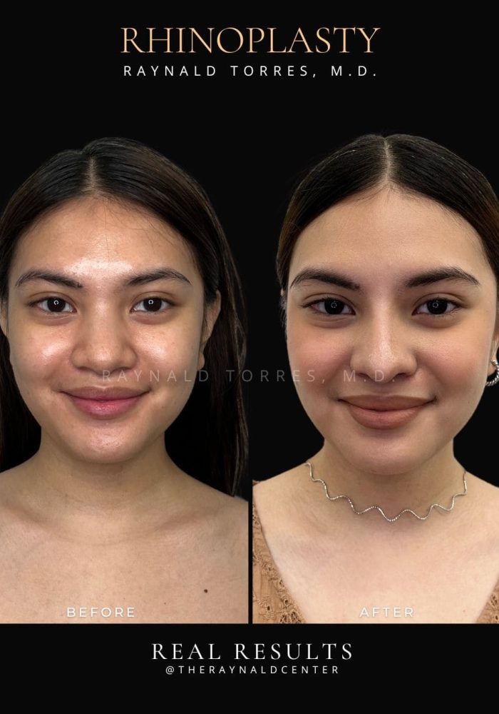 rhinoplasty59