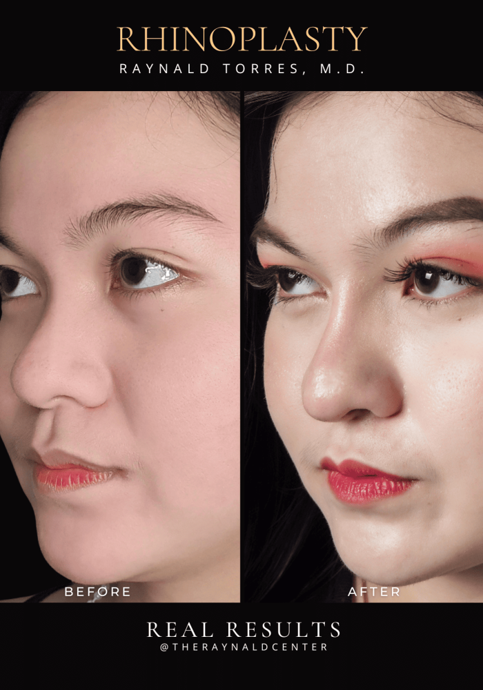rhinoplasty60