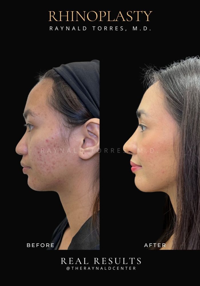 rhinoplasty61