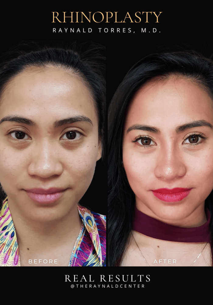 rhinoplasty7