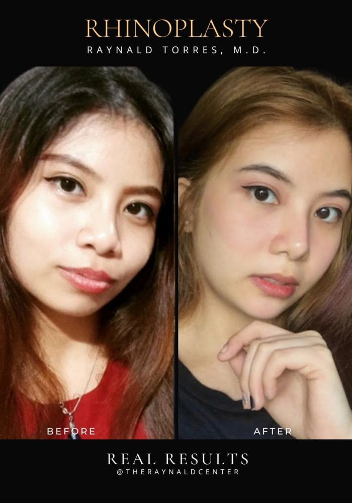 rhinoplasty8